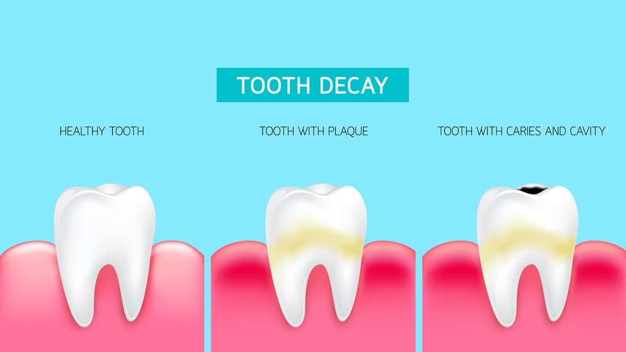 Tooth Decay Transcend Dental Care Orlando Dentist