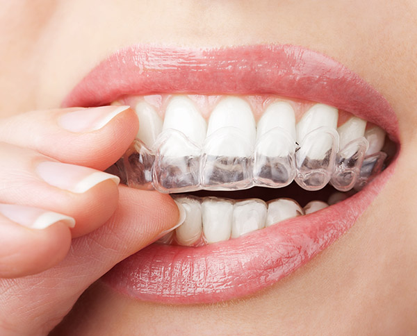 Invisalign: A Revolutionary Way to Straighten Your Teeth